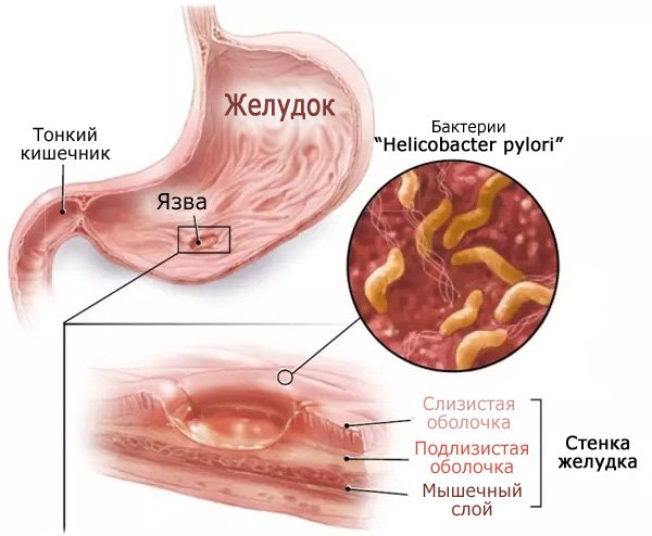 Язва желудка — симптомы, причины, диета и лечение язвы желудка