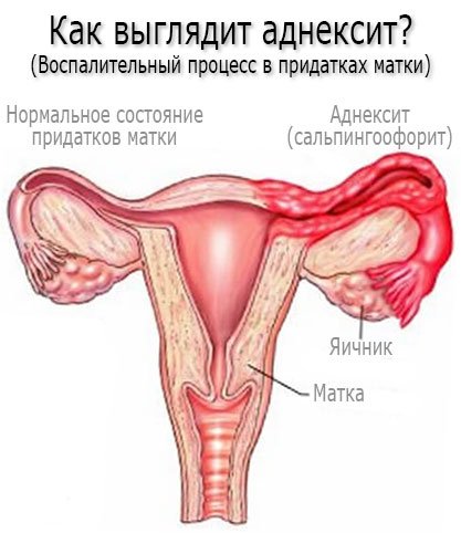 Аднексит – симптомы, причины, виды и лечение аднексита