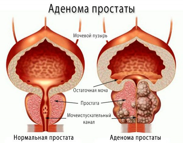 Аденома простаты – симптомы, причины, диета и лечение