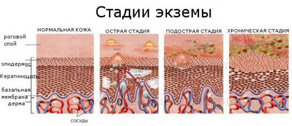 Экзема: причины, симптомы, виды и лечение экземы