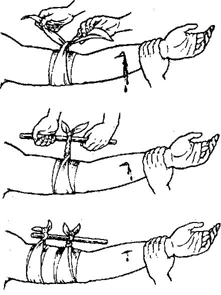 Венозное кровотечение первая помощь картинки