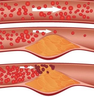 Атеросклероз — симптомы, причины и лечение атеросклероза