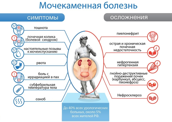 Мочекаменная болезнь — заболевание